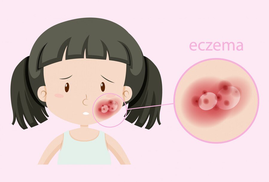 Eczema | Dermatologist