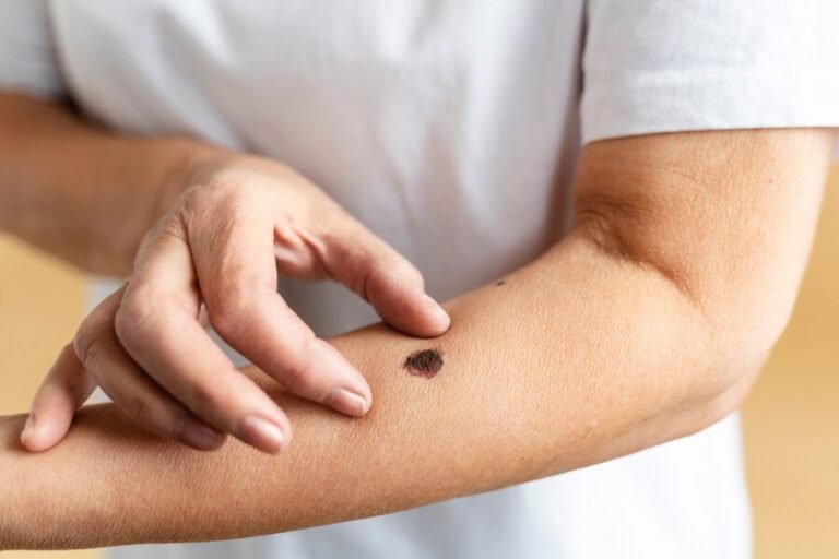 Mole on an arm