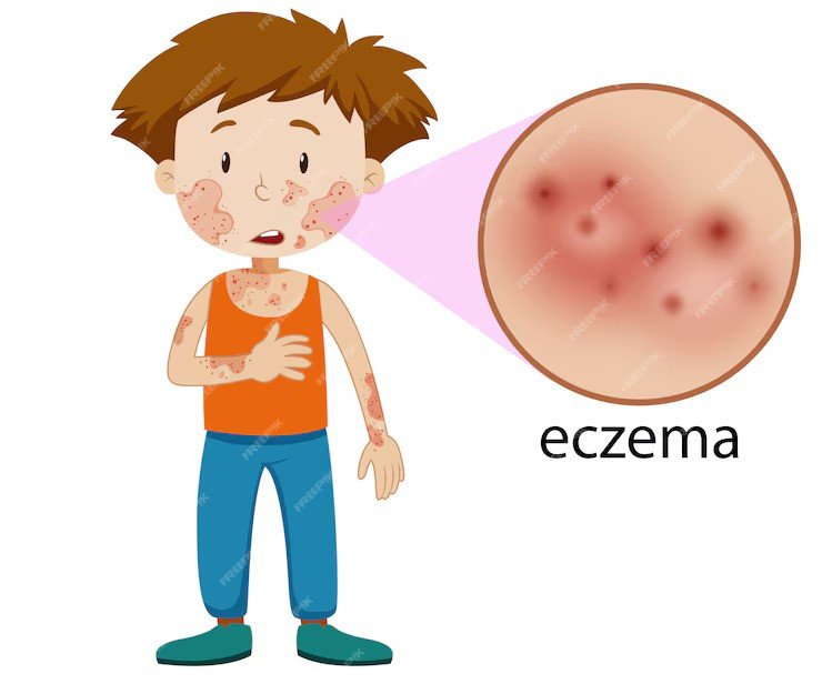 Eczema | Dermatologist